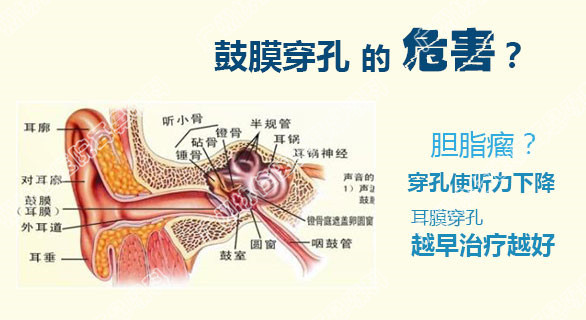 如何预防鼓膜穿孔