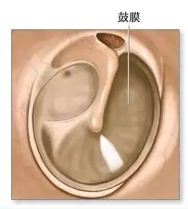 你对鼓膜穿孔了解吗？