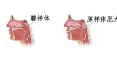 咽腺肥大是怎么回事？