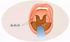 重庆耳鼻喉科医院,扁桃体炎的预防措施