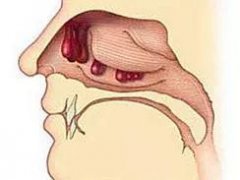 重庆耳鼻喉科医院_鼻息肉的危害有多严重