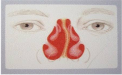 鼻中隔偏曲的病因有哪些