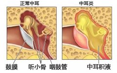 中耳炎要如何治疗？造成中耳炎的原因有哪些？
