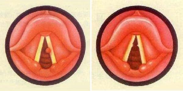 声音嘶哑的原因