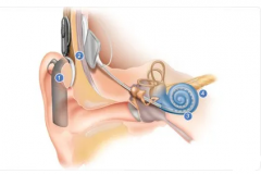 耳聋适应不了助听器？可以试试人工耳蜗