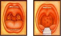 重庆耳鼻喉科医院-儿童腺样体肥大是什么症状