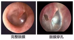 【科普】鼓膜穿孔是怎么回事