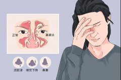 鼻窦炎的症状表现有哪些？重庆耳鼻喉科医院