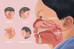 孩子腺样体肥大怎么办?一定要手术治疗吗？