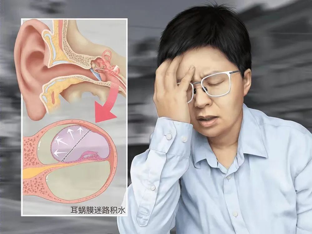 美尼尔氏综合征