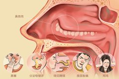 鼻息肉临床症状以及可引发的并发症