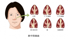 重庆看鼻中隔偏曲医院，鼻中隔偏曲怎么矫正