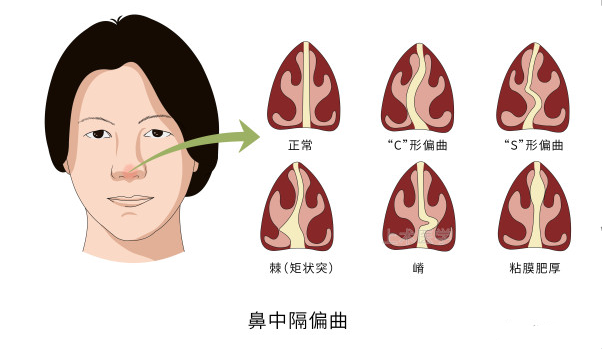 鼻中隔偏曲