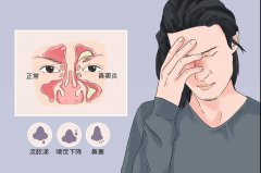 重庆鼻窦炎医院，重庆专业看鼻窦炎的医院