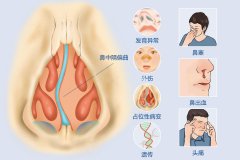 重庆看鼻中隔偏曲医院，重庆鼻中隔偏曲矫正