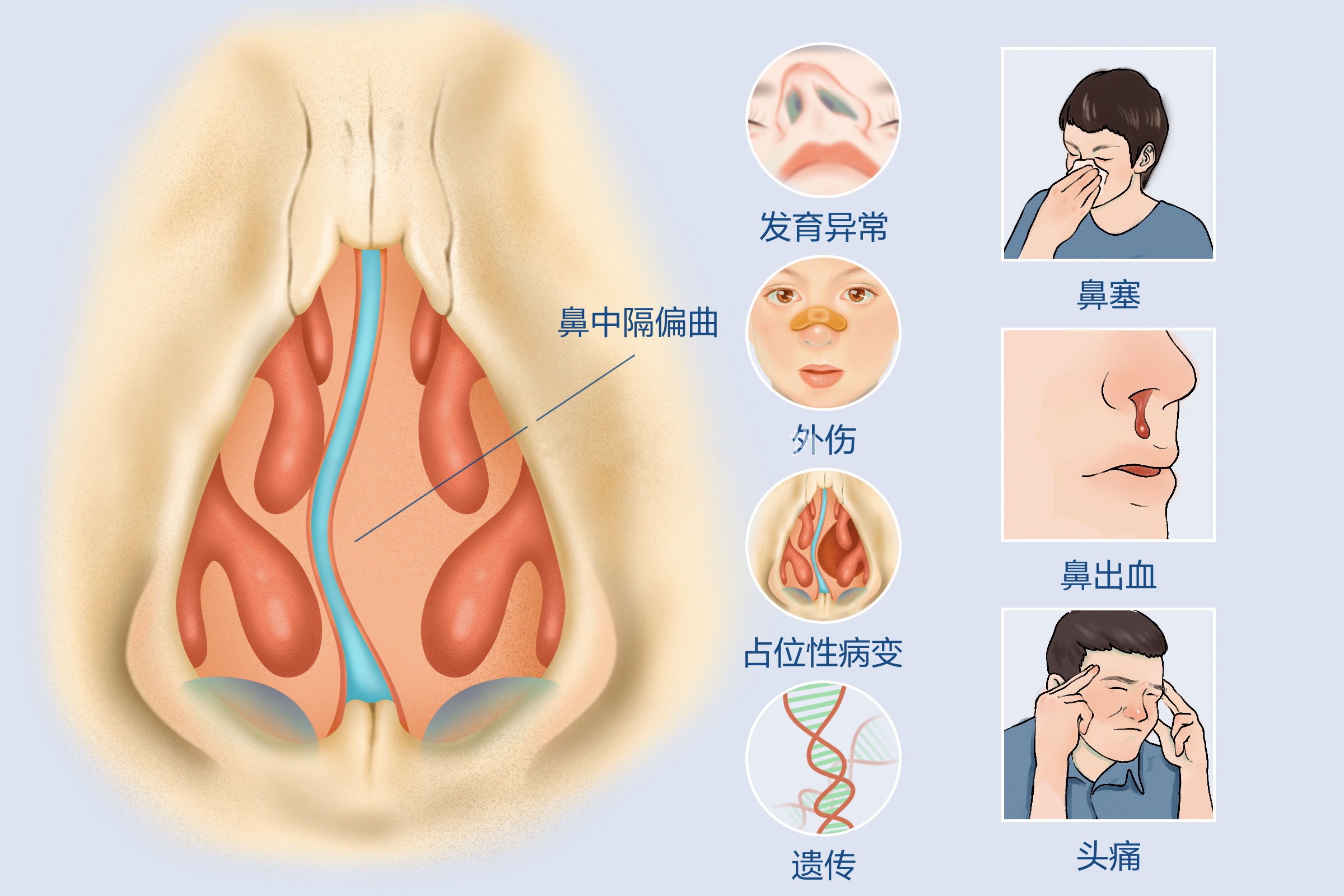 鼻中隔偏曲