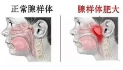 为什么现在腺样体肥大的孩子越来越多？耳鼻喉医生跟你说实话
