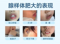 孩子腺样体肥大到底要不要管？耳鼻喉科医生的实话来了