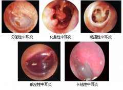 医生详解 什么是中耳炎及治疗方法